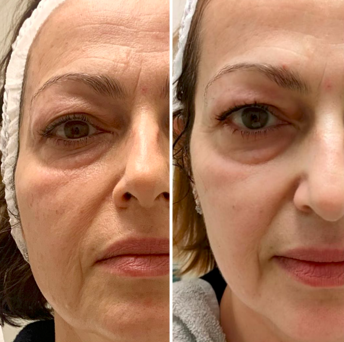 Eye & Cheek Area — Before and after facial treatment