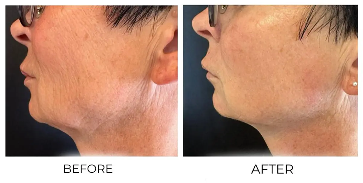 Face & Neck — Before and after T-Shape treatment series