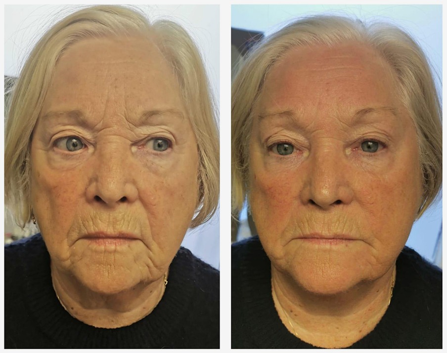 Full Face — Before and after T-Shape facial treatment