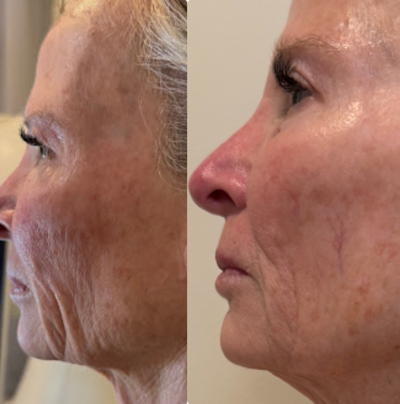 Face & Jawline — Before and after T-Shape facial treatment