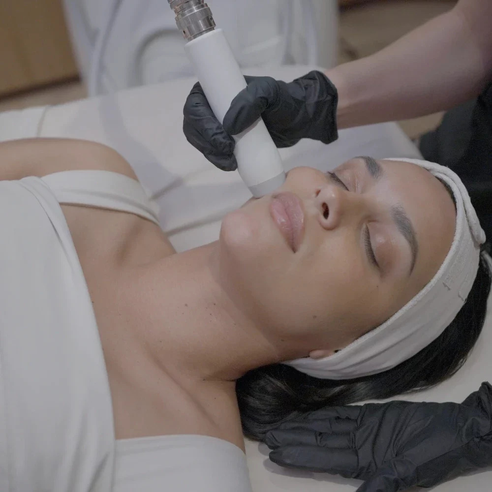 T-Shape facial treatment on the cheek at iCRYO Fairfield
